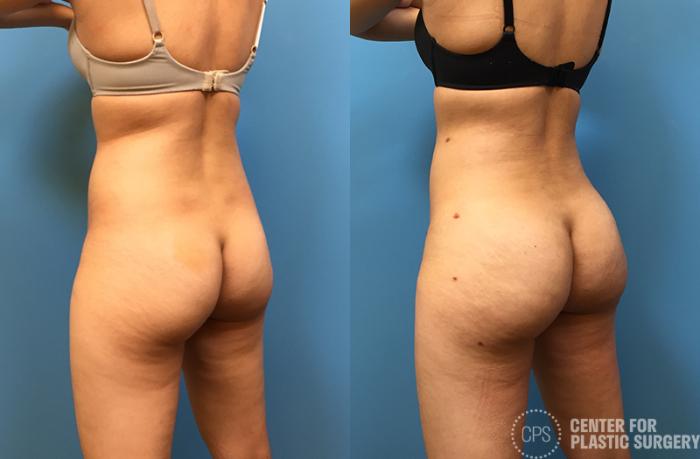 Brazilian Butt Lift Case 73 Before & After Left Oblique | Chevy Chase & Annandale, Washington D.C. Metropolitan Area | Center for Plastic Surgery