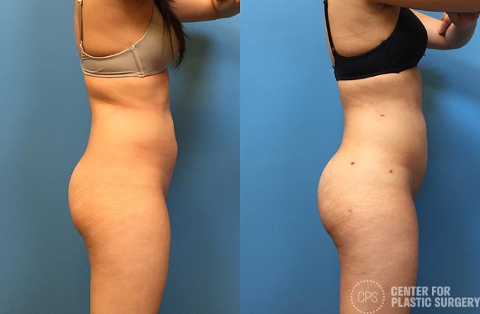 Brazilian Butt Lift Case 73 Before & After Right Side | Chevy Chase & Annandale, Washington D.C. Metropolitan Area | Center for Plastic Surgery
