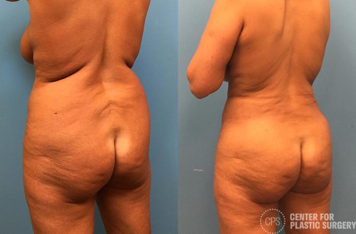 Brazilian Butt Lift Case 74 Before & After Back Left Oblique | Chevy Chase & Annandale, Washington D.C. Metropolitan Area | Center for Plastic Surgery