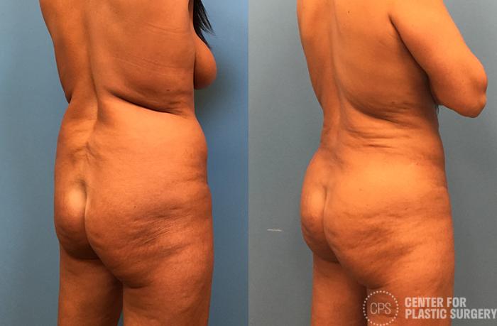 Brazilian Butt Lift Case 74 Before & After Back Right Oblique | Chevy Chase & Annandale, Washington D.C. Metropolitan Area | Center for Plastic Surgery