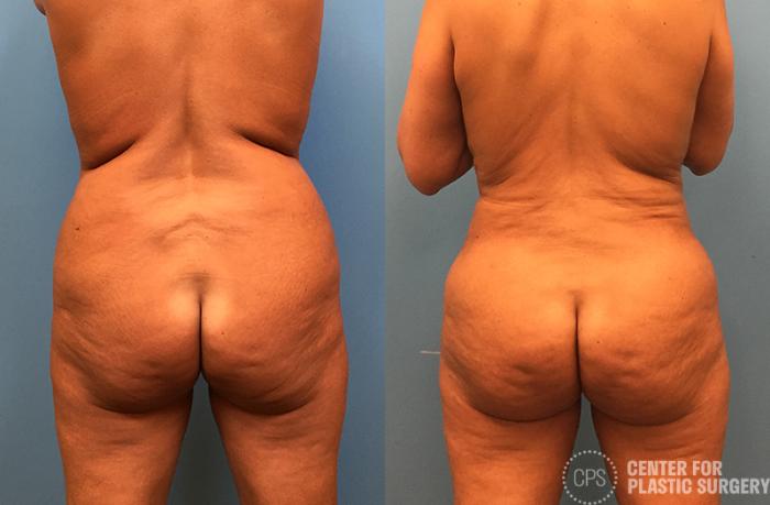Brazilian Butt Lift Case 74 Before & After Back | Chevy Chase & Annandale, Washington D.C. Metropolitan Area | Center for Plastic Surgery