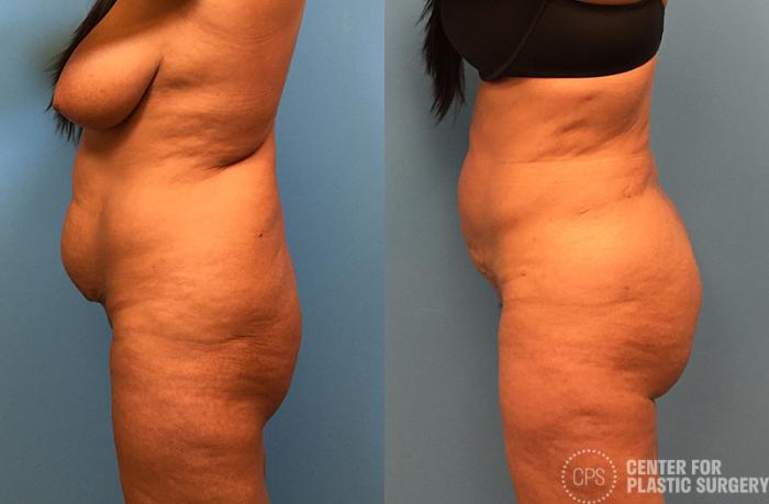 Brazilian Butt Lift Before & After Photos of Patient at The Center