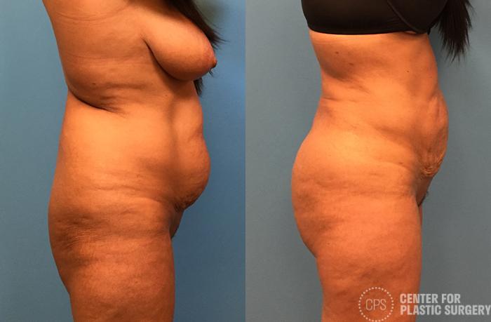 Brazilian Butt Lift Case 74 Before & After Right Side | Chevy Chase & Annandale, Washington D.C. Metropolitan Area | Center for Plastic Surgery