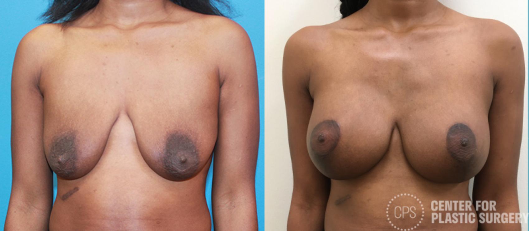 Breast Augmentation with Lift Case 100 Before & After Front | Annandale, Washington D.C. Metropolitan Area | Center for Plastic Surgery