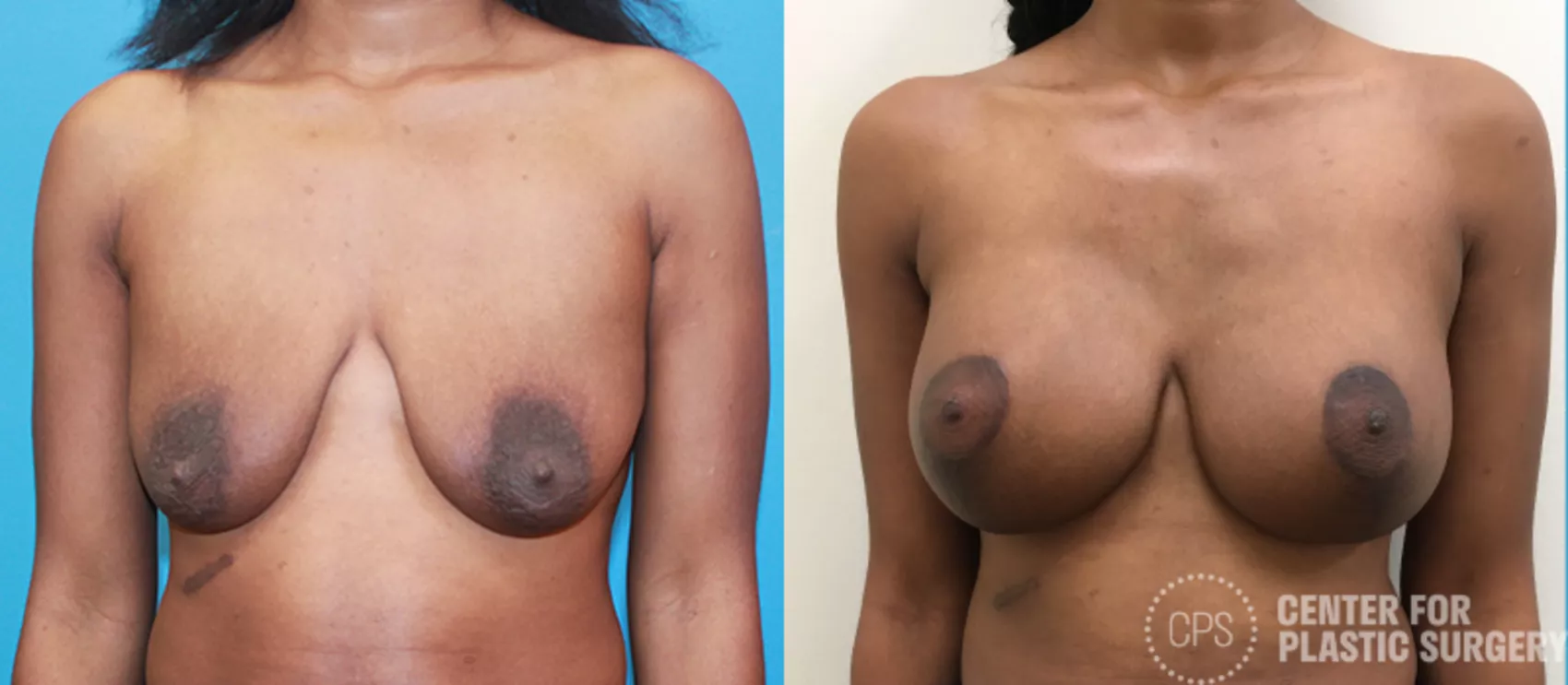 Breast Augmentation Case 100 Before & After Front | Annandale, Washington D.C. Metropolitan Area | Center for Plastic Surgery