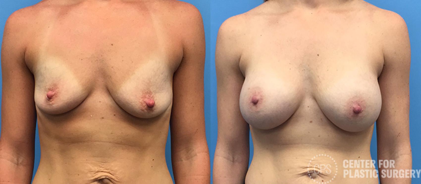 Breast Augmentation Case 101 Before & After Front | Chevy Chase & Annandale, Washington D.C. Metropolitan Area | Center for Plastic Surgery