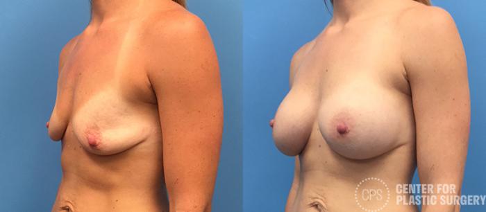 Breast Augmentation Case 101 Before & After Left Oblique | Chevy Chase & Annandale, Washington D.C. Metropolitan Area | Center for Plastic Surgery