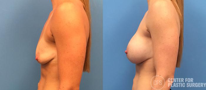 Breast Augmentation Case 101 Before & After Left Side | Chevy Chase & Annandale, Washington D.C. Metropolitan Area | Center for Plastic Surgery