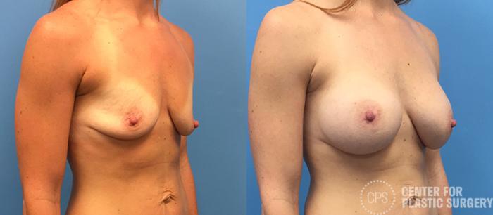 Breast Augmentation Case 101 Before & After Right Oblique | Chevy Chase & Annandale, Washington D.C. Metropolitan Area | Center for Plastic Surgery