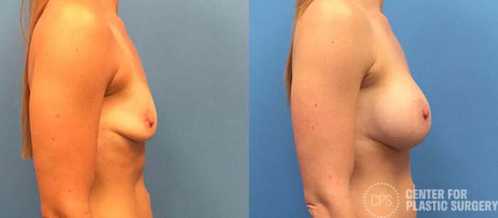 Breast Augmentation Case 101 Before & After Right Side | Chevy Chase & Annandale, Washington D.C. Metropolitan Area | Center for Plastic Surgery