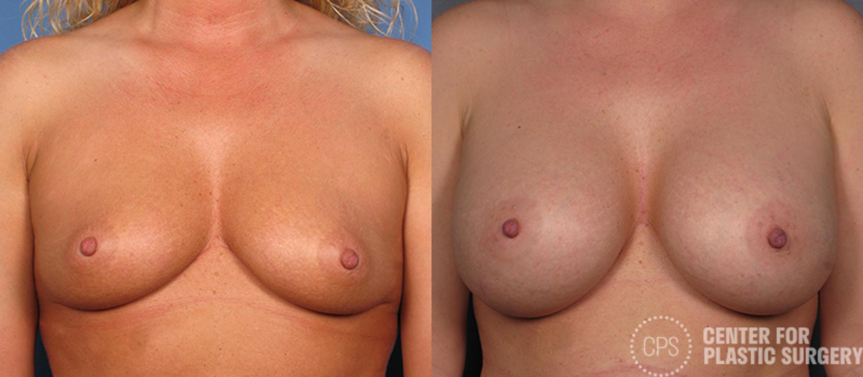Breast Augmentation Case 102 Before & After Front | Washington, DC, Washington D.C. Metropolitan Area | Center for Plastic Surgery