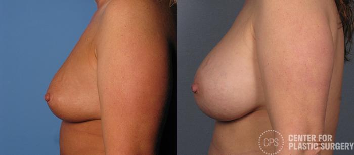 Breast Augmentation Case 102 Before & After Left Side | Chevy Chase & Annandale, Washington D.C. Metropolitan Area | Center for Plastic Surgery
