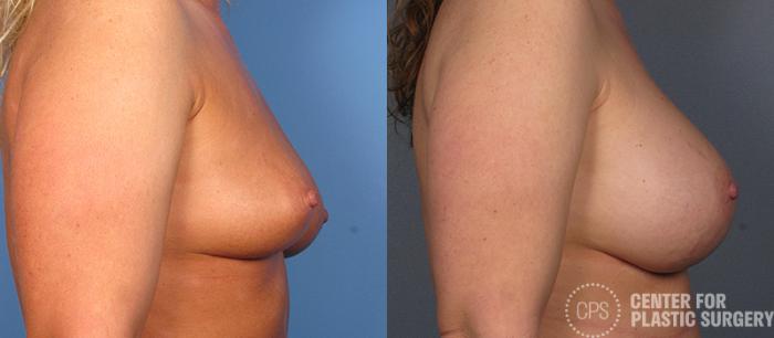 Breast Augmentation Case 102 Before & After Right Side | Chevy Chase & Annandale, Washington D.C. Metropolitan Area | Center for Plastic Surgery