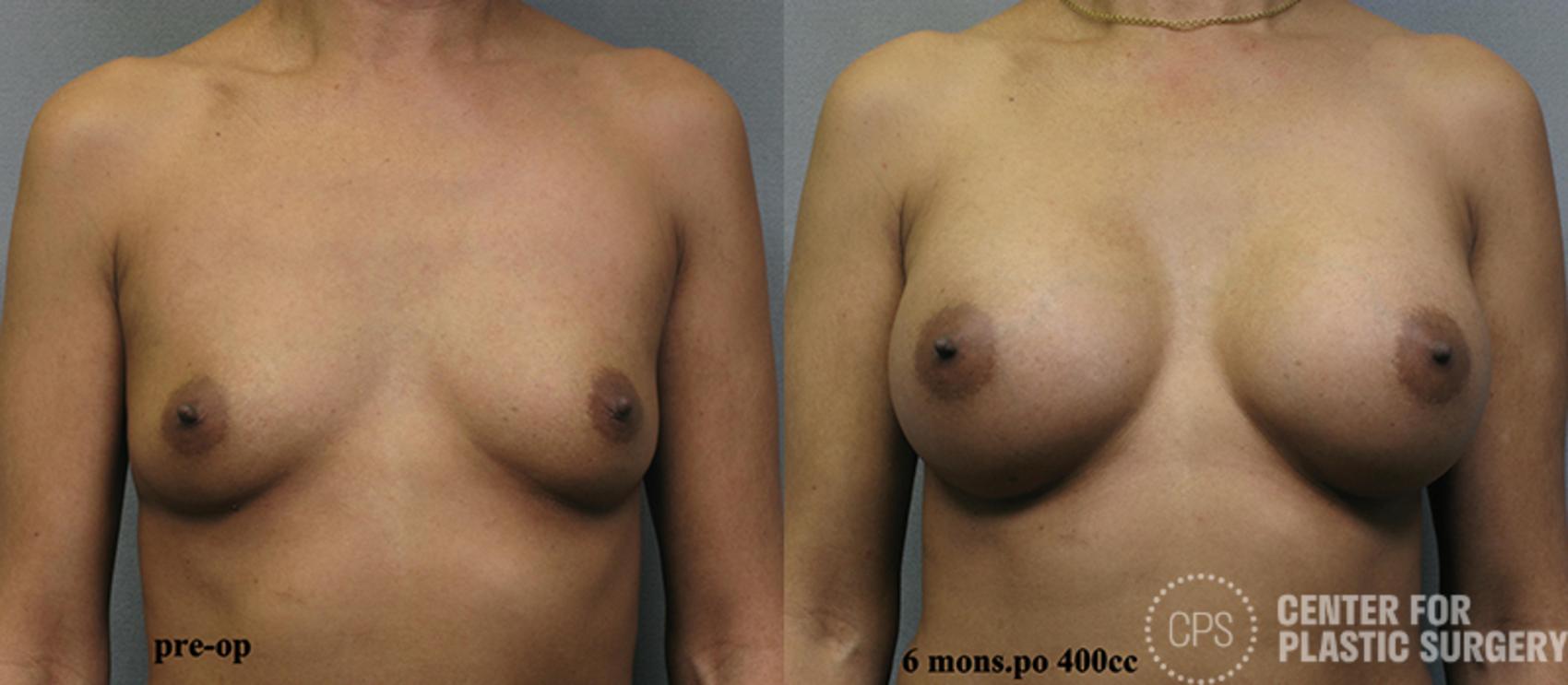 Breast Augmentation Case 105 Before & After Front | Chevy Chase & Annandale, Washington D.C. Metropolitan Area | Center for Plastic Surgery