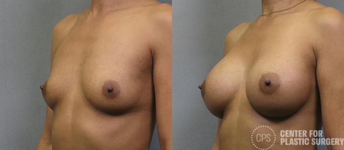 Breast Augmentation Case 105 Before & After Left Oblique | Chevy Chase & Annandale, Washington D.C. Metropolitan Area | Center for Plastic Surgery