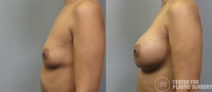 Breast Augmentation Case 105 Before & After Left Side | Chevy Chase & Annandale, Washington D.C. Metropolitan Area | Center for Plastic Surgery