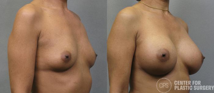 Breast Augmentation Case 105 Before & After Right Oblique | Chevy Chase & Annandale, Washington D.C. Metropolitan Area | Center for Plastic Surgery