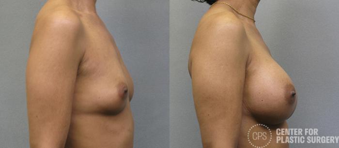 Breast Augmentation Case 105 Before & After Right Side | Chevy Chase & Annandale, Washington D.C. Metropolitan Area | Center for Plastic Surgery