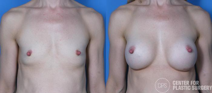 Breast Augmentation Case 106 Before & After Front | Chevy Chase & Annandale, Washington D.C. Metropolitan Area | Center for Plastic Surgery