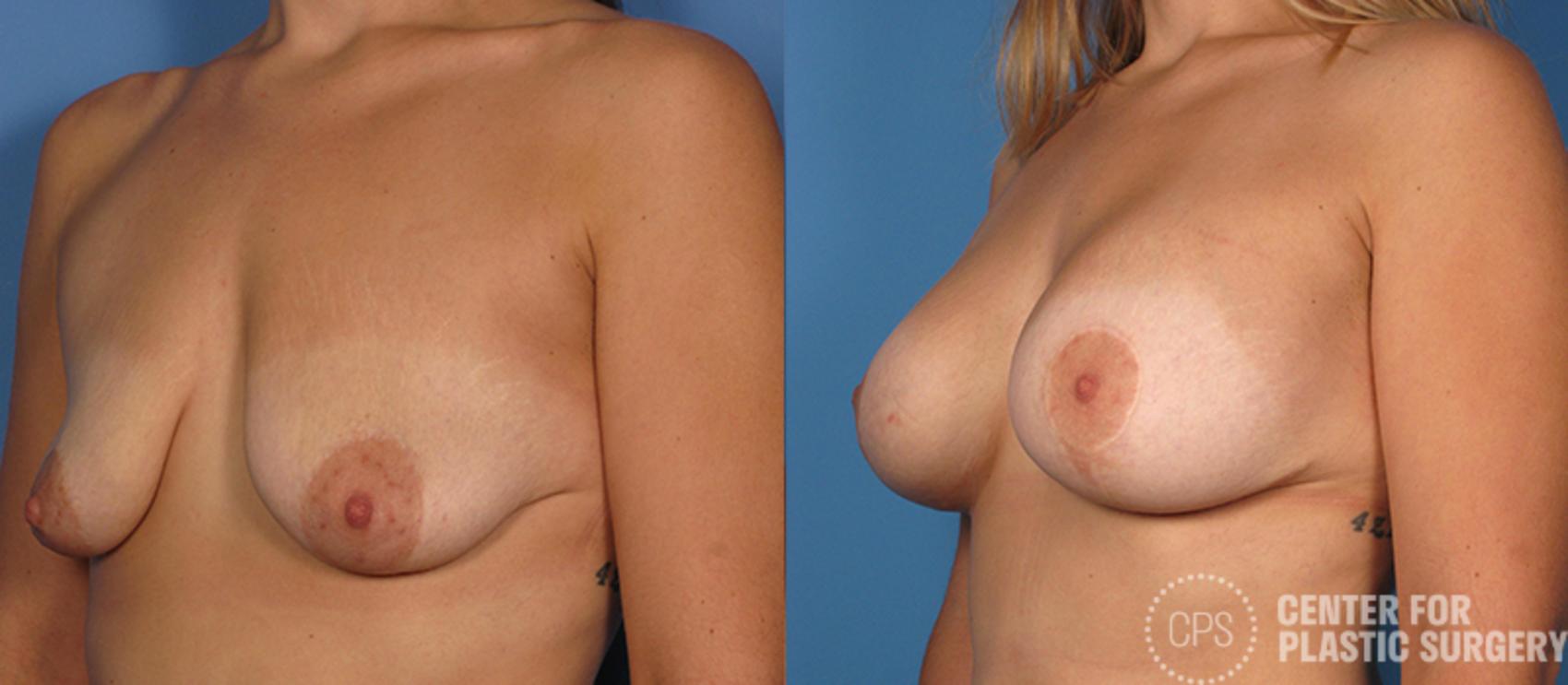 Breast Augmentation Case 107 Before & After Left Oblique | Annandale, Washington D.C. Metropolitan Area | Center for Plastic Surgery