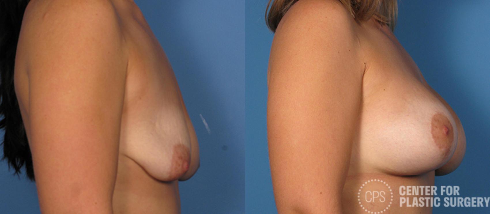 Breast Augmentation Case 107 Before & After Right Side | Annandale, Washington D.C. Metropolitan Area | Center for Plastic Surgery