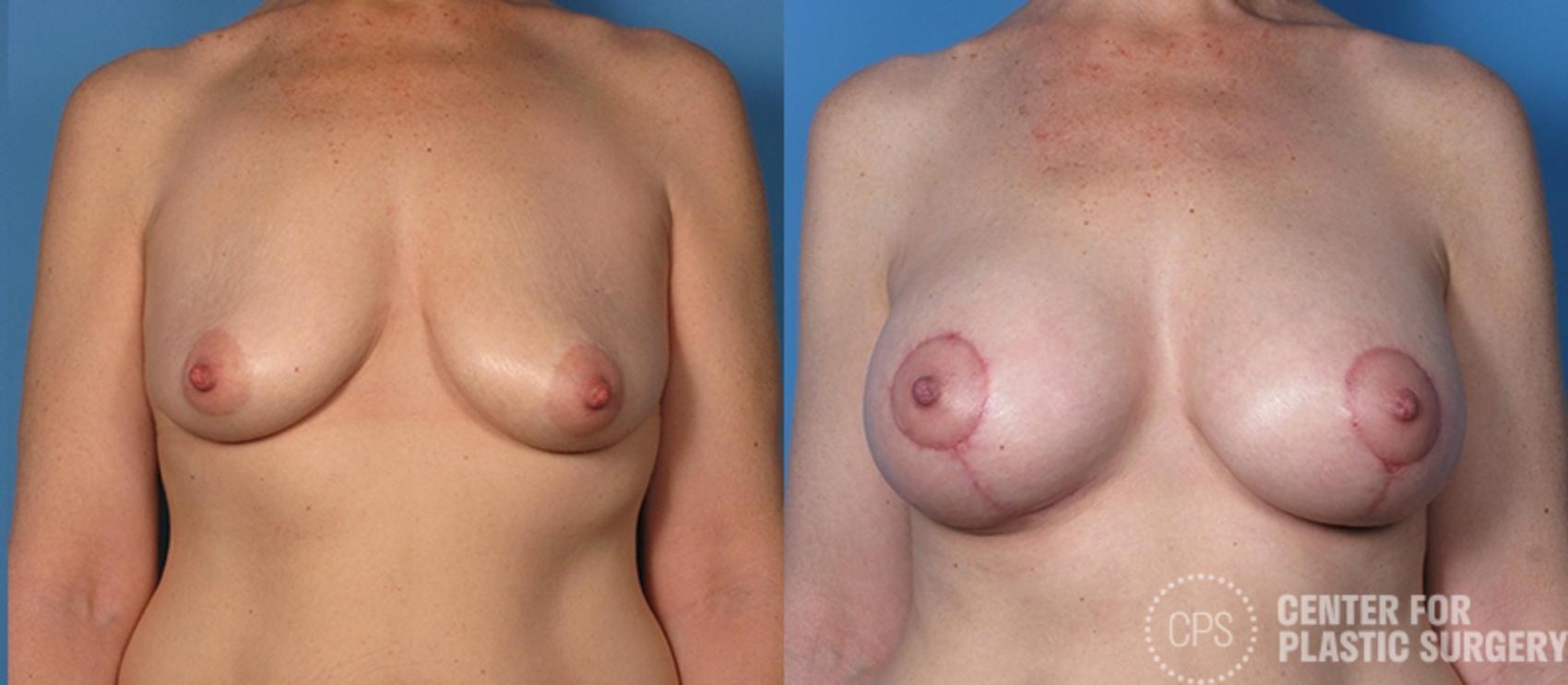 Breast Augmentation with Lift Case 108 Before & After Front | Annandale, Washington D.C. Metropolitan Area | Center for Plastic Surgery