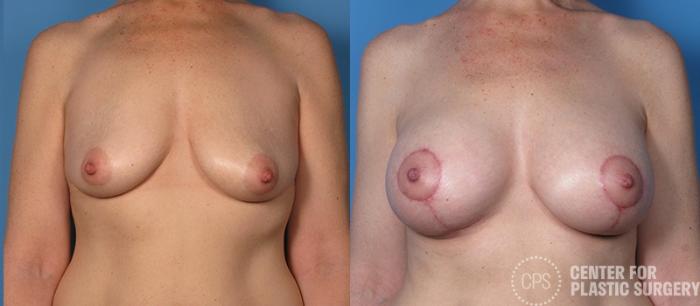 Breast Augmentation Case 108 Before & After Front | Chevy Chase & Annandale, Washington D.C. Metropolitan Area | Center for Plastic Surgery