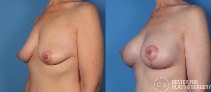 Breast Augmentation with Lift Case 108 Before & After Left Oblique | Chevy Chase & Annandale, Washington D.C. Metropolitan Area | Center for Plastic Surgery