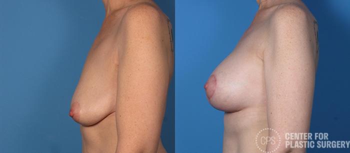 Breast Augmentation Case 108 Before & After Left Side | Chevy Chase & Annandale, Washington D.C. Metropolitan Area | Center for Plastic Surgery