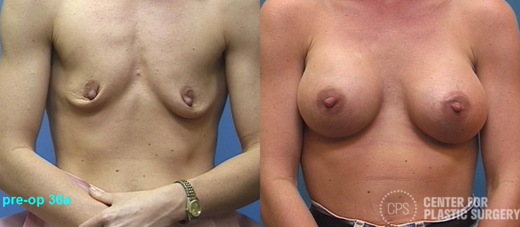 Breast Augmentation Case 109 Before & After Front | Annandale, Washington D.C. Metropolitan Area | Center for Plastic Surgery