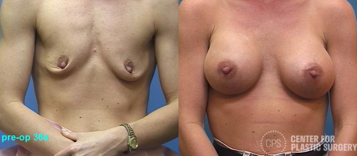 Breast Augmentation Case 109 Before & After Front | Chevy Chase & Annandale, Washington D.C. Metropolitan Area | Center for Plastic Surgery