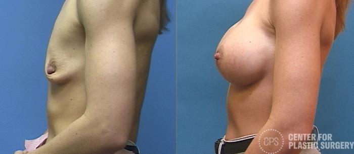 Breast Augmentation Case 109 Before & After Left Side | Chevy Chase & Annandale, Washington D.C. Metropolitan Area | Center for Plastic Surgery
