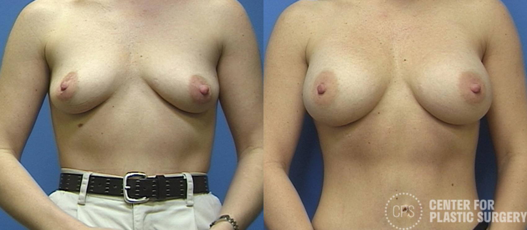 Breast Augmentation Case 110 Before & After Front | Chevy Chase & Annandale, Washington D.C. Metropolitan Area | Center for Plastic Surgery