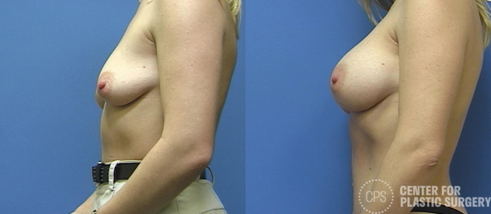 Breast Augmentation Case 110 Before & After Left Side | Chevy Chase & Annandale, Washington D.C. Metropolitan Area | Center for Plastic Surgery