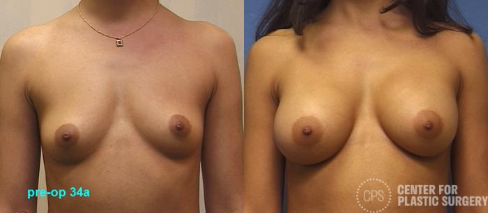Breast Augmentation Case 111 Before & After Front | Chevy Chase & Annandale, Washington D.C. Metropolitan Area | Center for Plastic Surgery