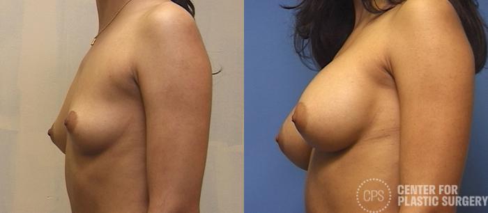 Breast Augmentation Case 111 Before & After Left Side | Chevy Chase & Annandale, Washington D.C. Metropolitan Area | Center for Plastic Surgery