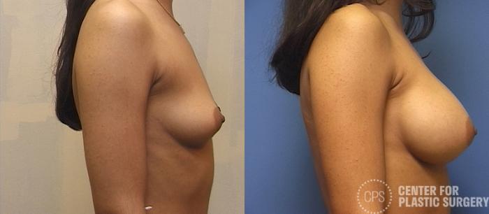 Breast Augmentation Case 111 Before & After Right Side | Chevy Chase & Annandale, Washington D.C. Metropolitan Area | Center for Plastic Surgery