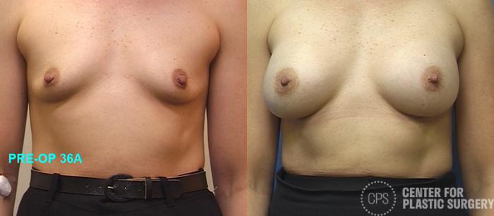 Breast Augmentation Case 113 Before & After Front | Chevy Chase & Annandale, Washington D.C. Metropolitan Area | Center for Plastic Surgery