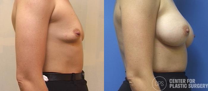 Breast Augmentation Case 113 Before & After Right Side | Chevy Chase & Annandale, Washington D.C. Metropolitan Area | Center for Plastic Surgery