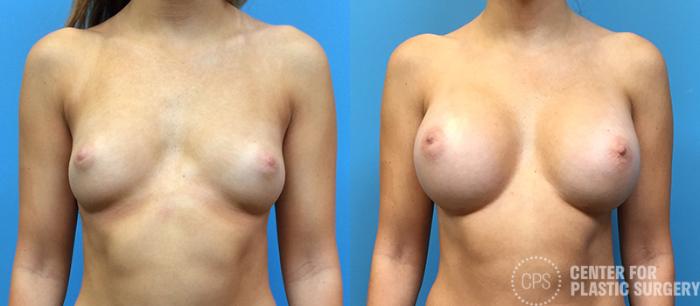 Breast Augmentation Case 114 Before & After Front | Chevy Chase & Annandale, Washington D.C. Metropolitan Area | Center for Plastic Surgery