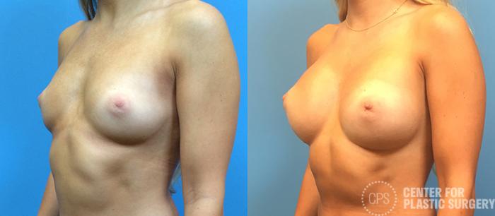 Breast Augmentation Case 114 Before & After Left Oblique | Chevy Chase & Annandale, Washington D.C. Metropolitan Area | Center for Plastic Surgery