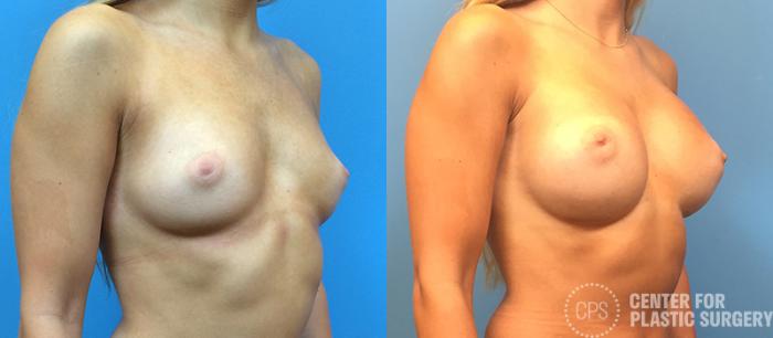 Breast Augmentation Case 114 Before & After Right Oblique | Chevy Chase & Annandale, Washington D.C. Metropolitan Area | Center for Plastic Surgery