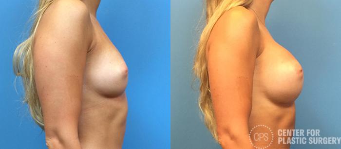 Breast Augmentation Case 114 Before & After Right Side | Chevy Chase & Annandale, Washington D.C. Metropolitan Area | Center for Plastic Surgery