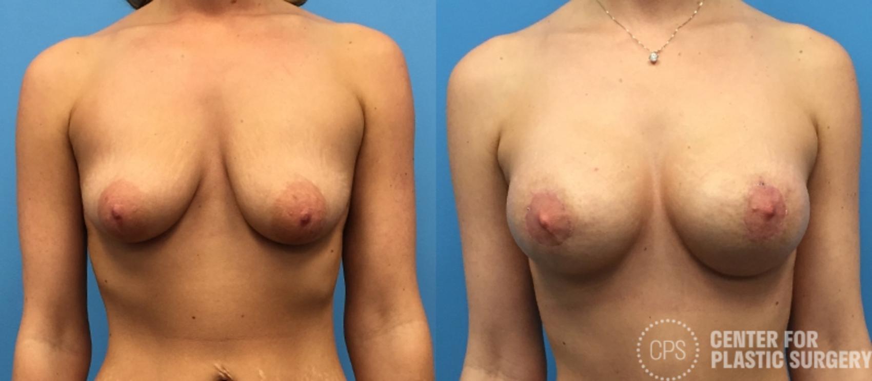 Breast Augmentation with Lift Case 116 Before & After Front | Annandale, Washington D.C. Metropolitan Area | Center for Plastic Surgery