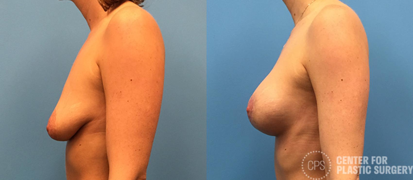 Breast Augmentation Case 116 Before & After Left Side | Annandale, Washington D.C. Metropolitan Area | Center for Plastic Surgery