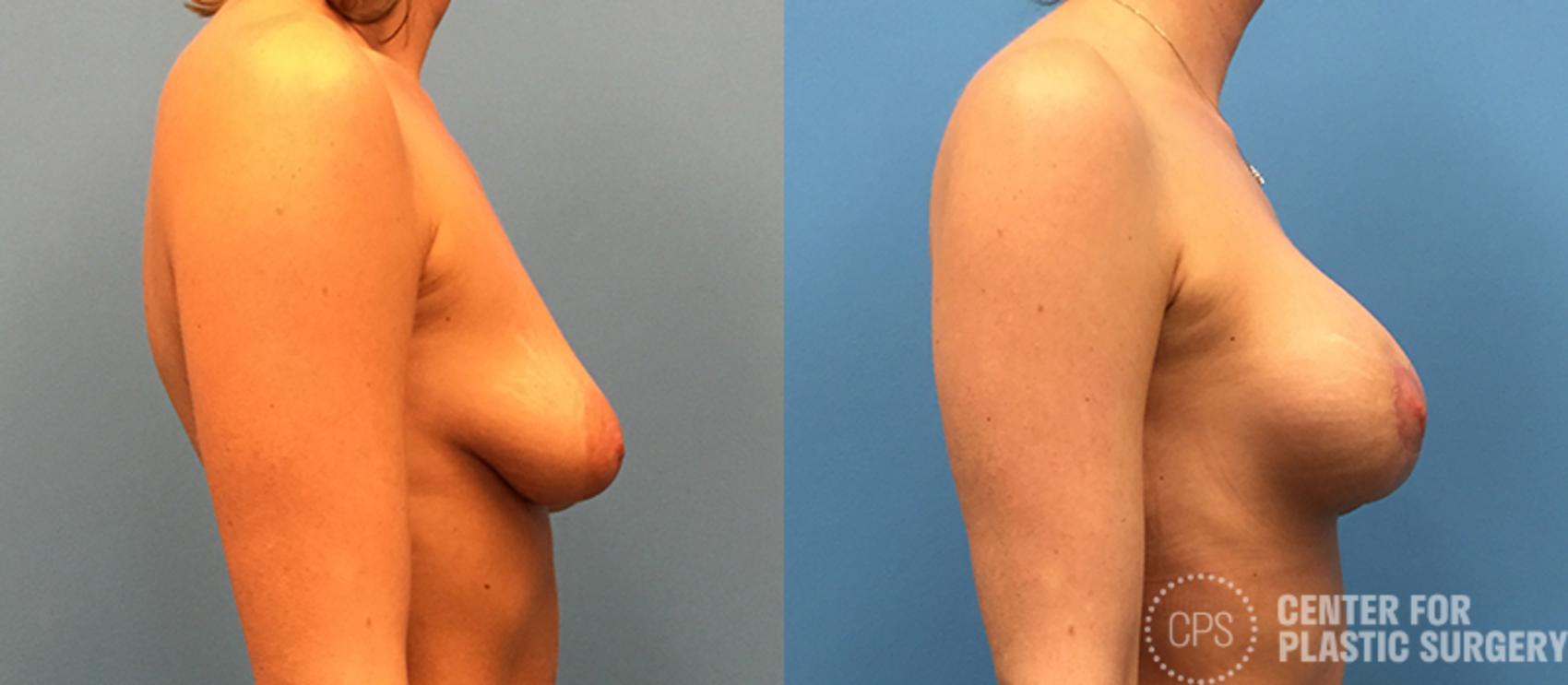 Breast Augmentation Case 116 Before & After Right Side | Annandale, Washington D.C. Metropolitan Area | Center for Plastic Surgery
