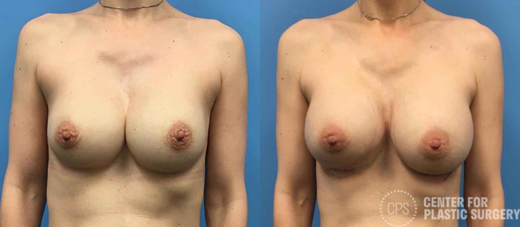 Breast Augmentation Case 117 Before & After Front | Annandale, Washington D.C. Metropolitan Area | Center for Plastic Surgery