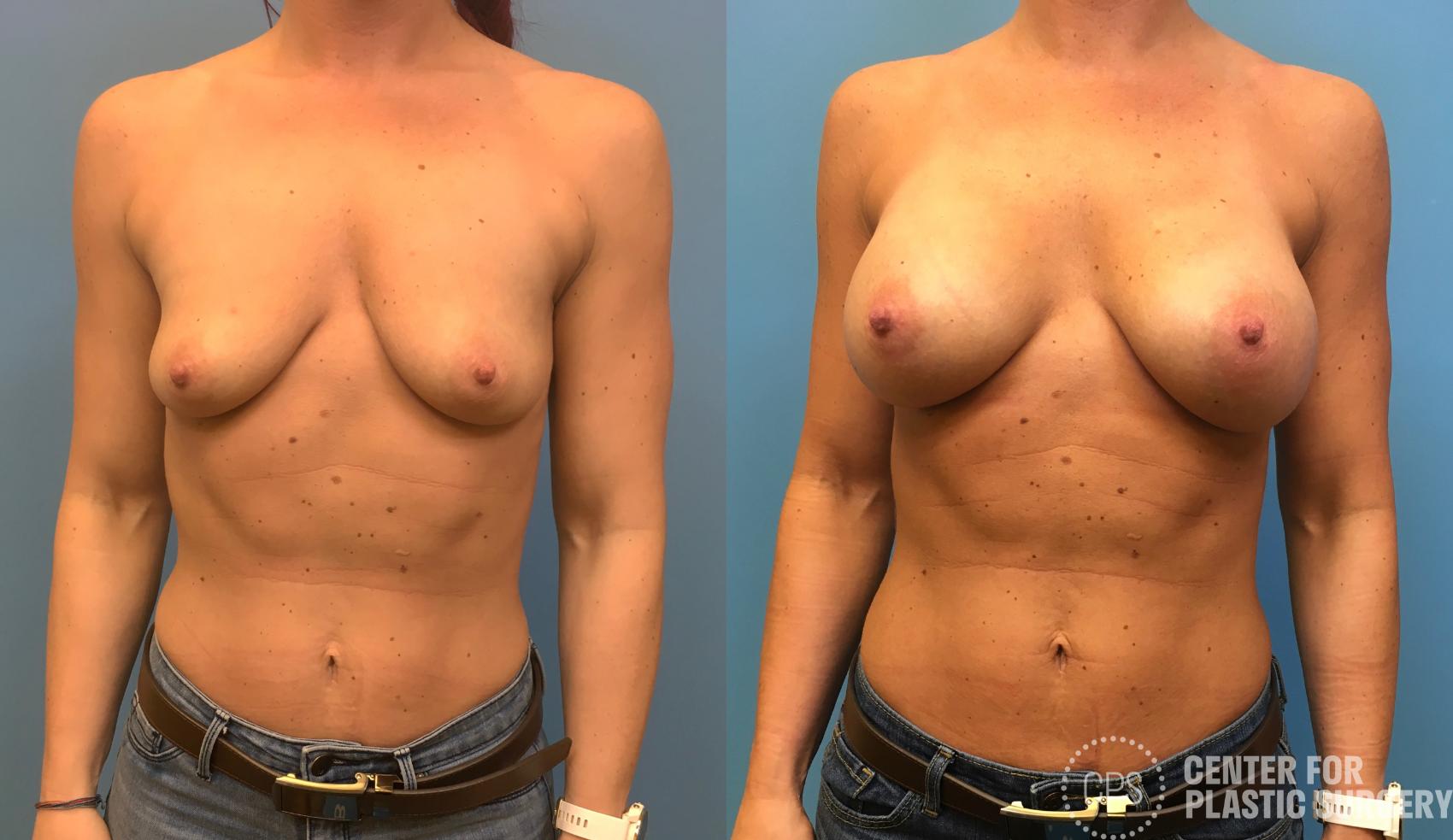 Breast Augmentation Case 160 Before & After Front | Chevy Chase & Annandale, Washington D.C. Metropolitan Area | Center for Plastic Surgery
