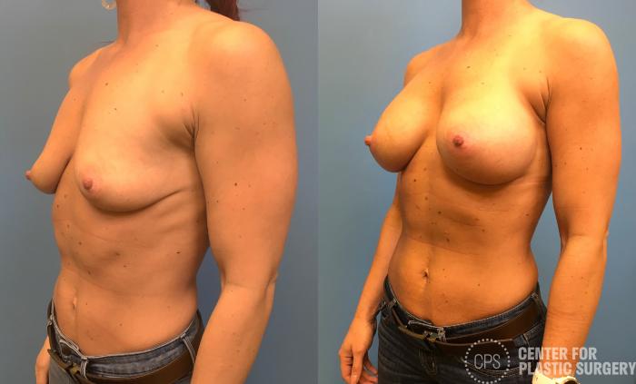 Breast Augmentation Case 160 Before & After Left Oblique | Chevy Chase & Annandale, Washington D.C. Metropolitan Area | Center for Plastic Surgery