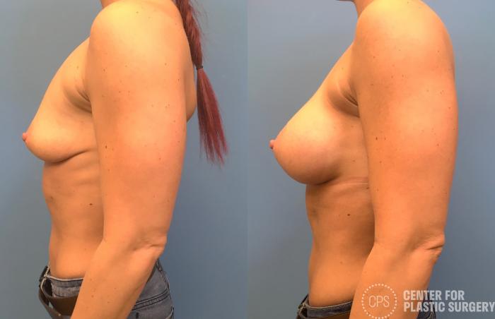 Breast Augmentation Case 160 Before & After Left Side | Chevy Chase & Annandale, Washington D.C. Metropolitan Area | Center for Plastic Surgery